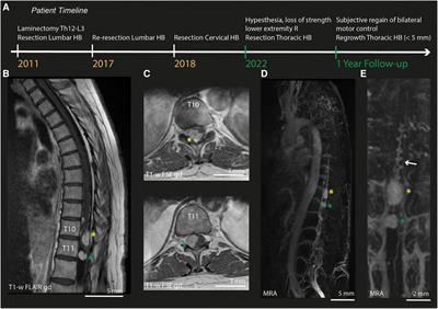 Case report: High-resolution, intra-operative µDoppler-imaging of spinal cord hemangioblastoma